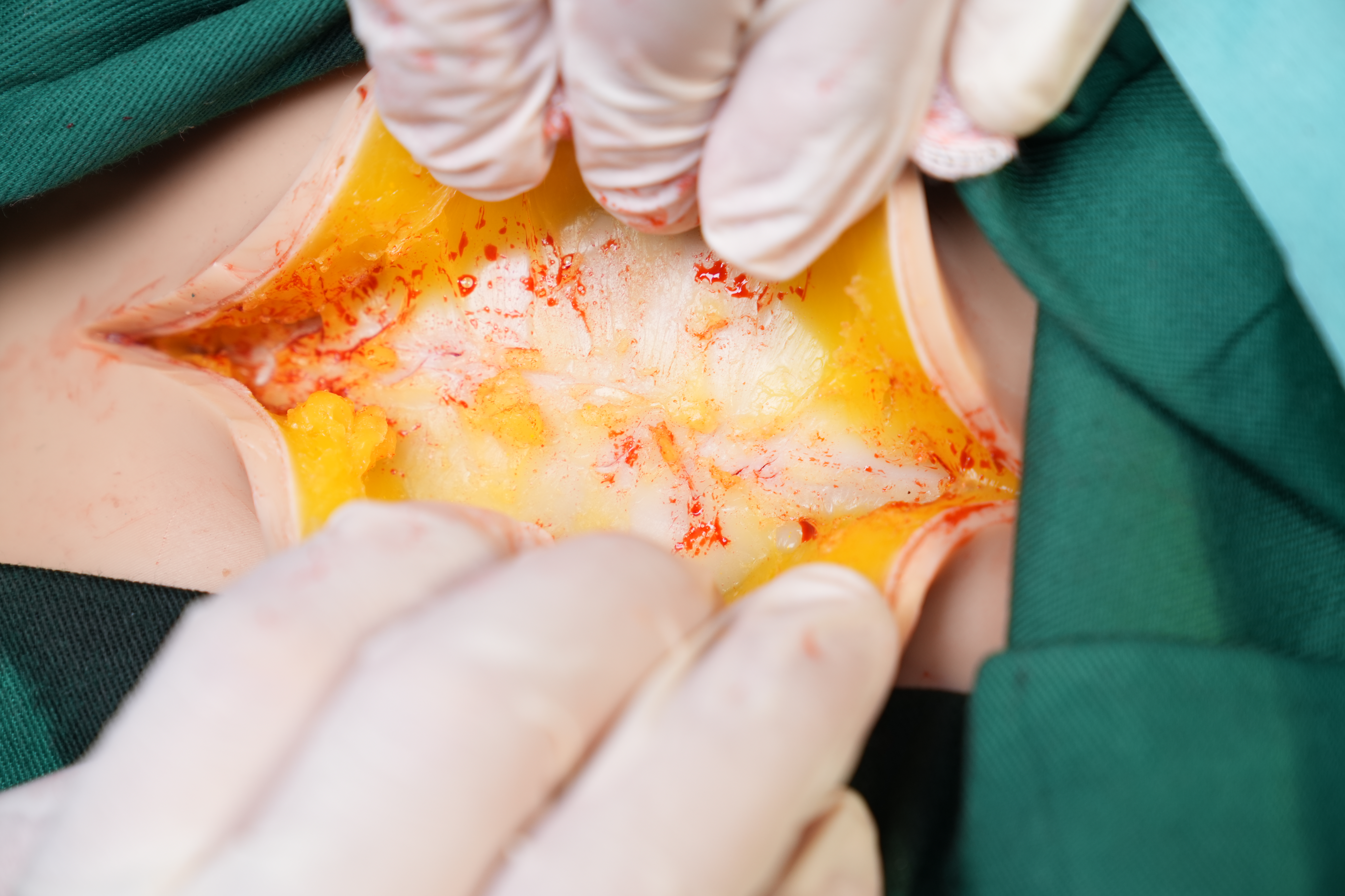 剖宮產(chǎn)手術(shù)平臺 2.0